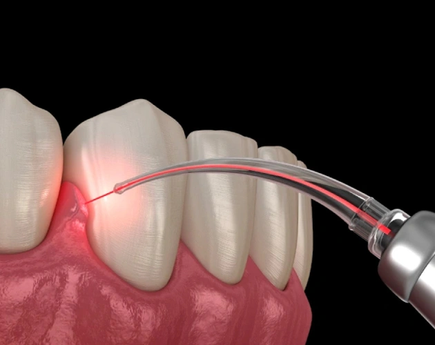 Laser gum treatment on front teeth demonstrating periodontal therapy procedure with red light technology.