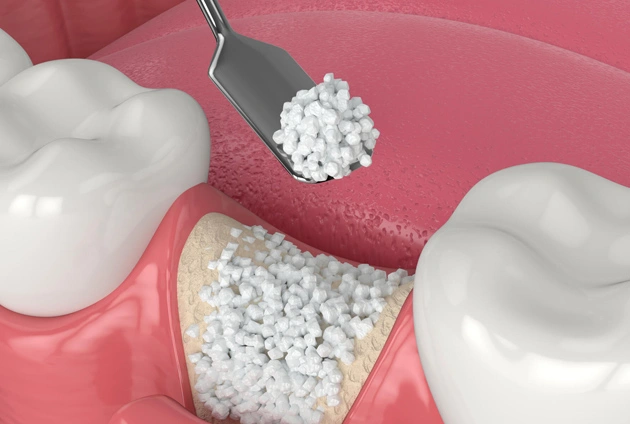 Dental implant procedure showing bone graft material placement between teeth on pink surgical field.