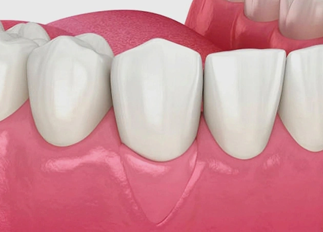 Dental model showing white tooth crowns on pink gum base for implant demonstration.