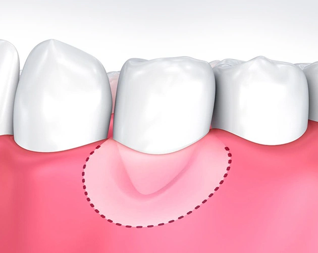 Dental illustration showing three white teeth with pink gum tissue and dotted surgical line indicating bone grafting procedure.