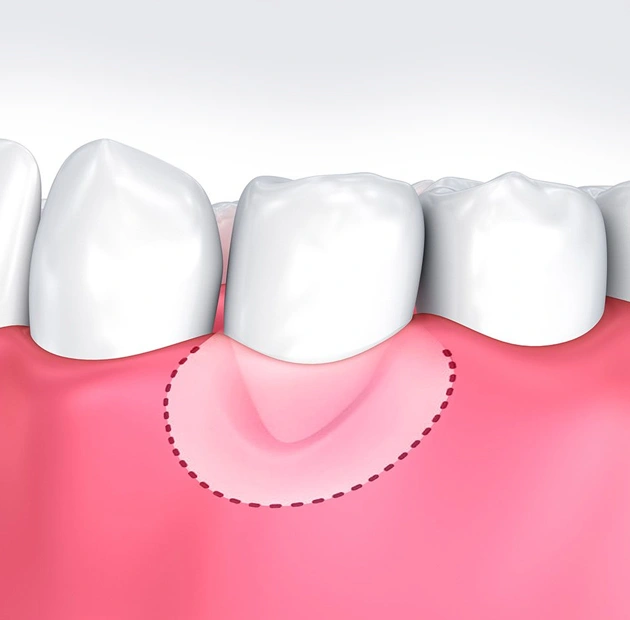 Dental implant illustration showing three white teeth above pink gum tissue with surgical outline.