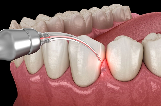 Dental laser treatment demonstrating gum disease therapy on tooth model with periodontal illustration.