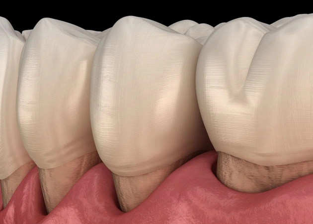 Three dental crowns or implants displayed on pink gum model showing dental restoration.