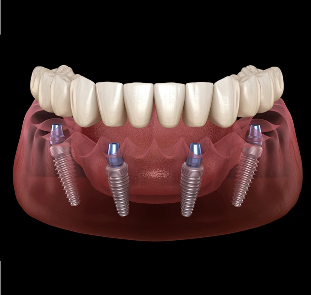 Dental implant model showing four titanium implants in jawbone with ceramic crown restoration.