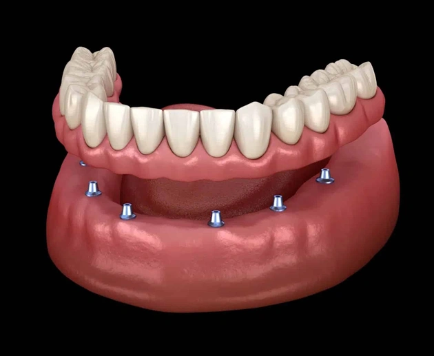 Dental implant model showing prosthetic teeth anchored to lower jawbone with implant posts.