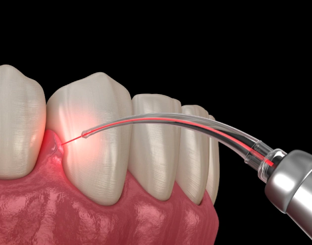 Dental laser treating gum tissue between teeth for periodontal therapy or implant procedure.