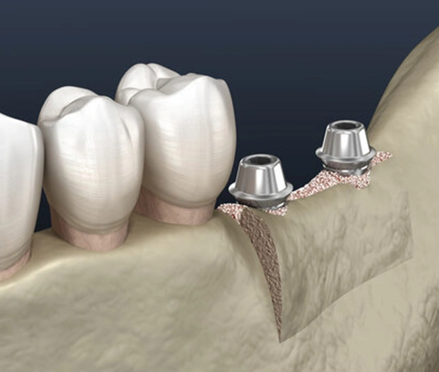 Dental implant abutments positioned in jawbone next to natural teeth model.