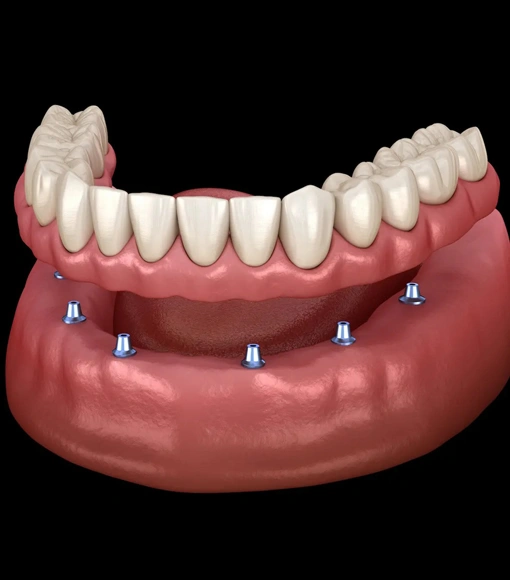 all on 4 dental implants colorado springs