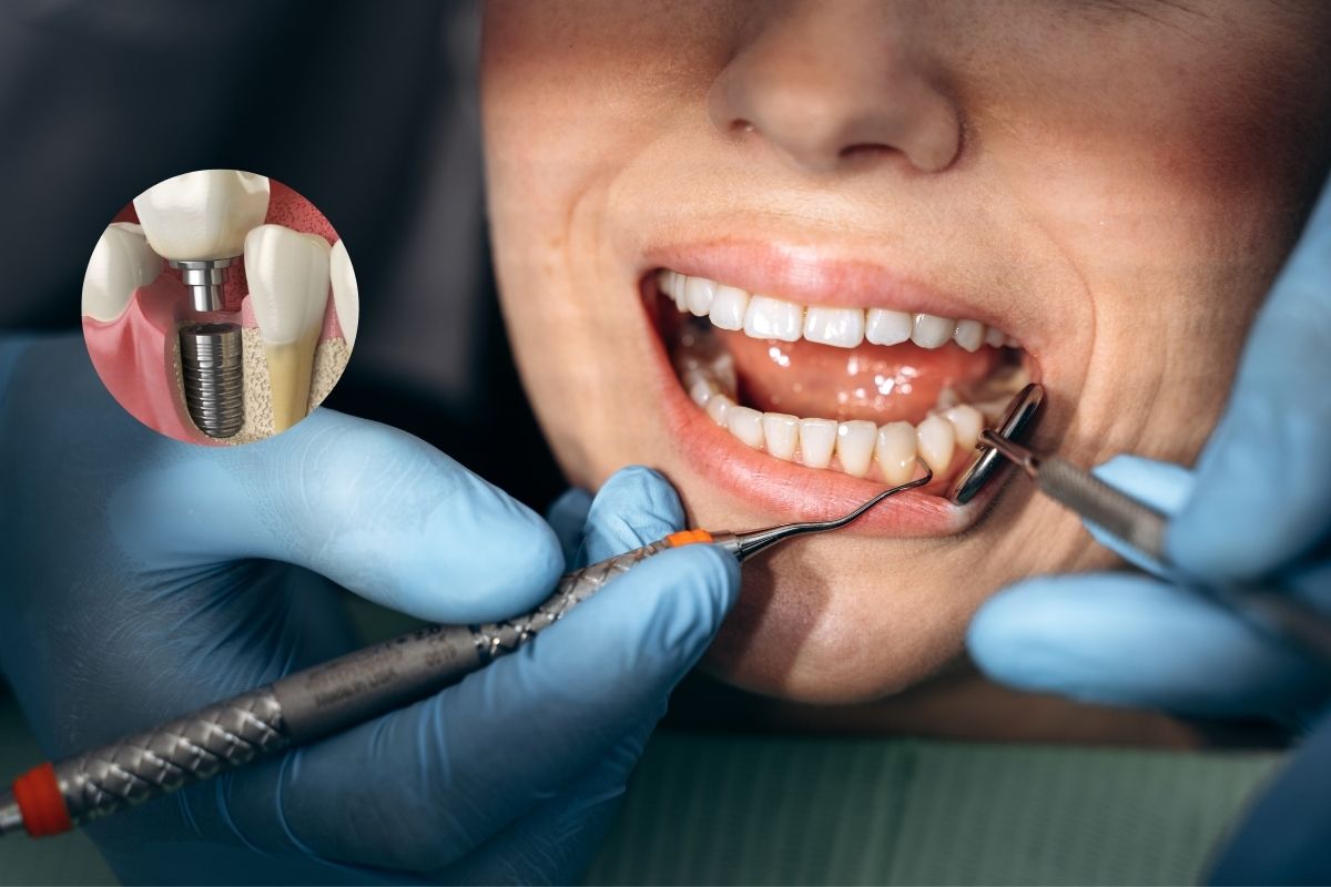 Is It Safe to Get Implants With Active Gum Disease